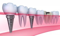 Implantología oral: preguntas frecuentes sobre implantes dentales