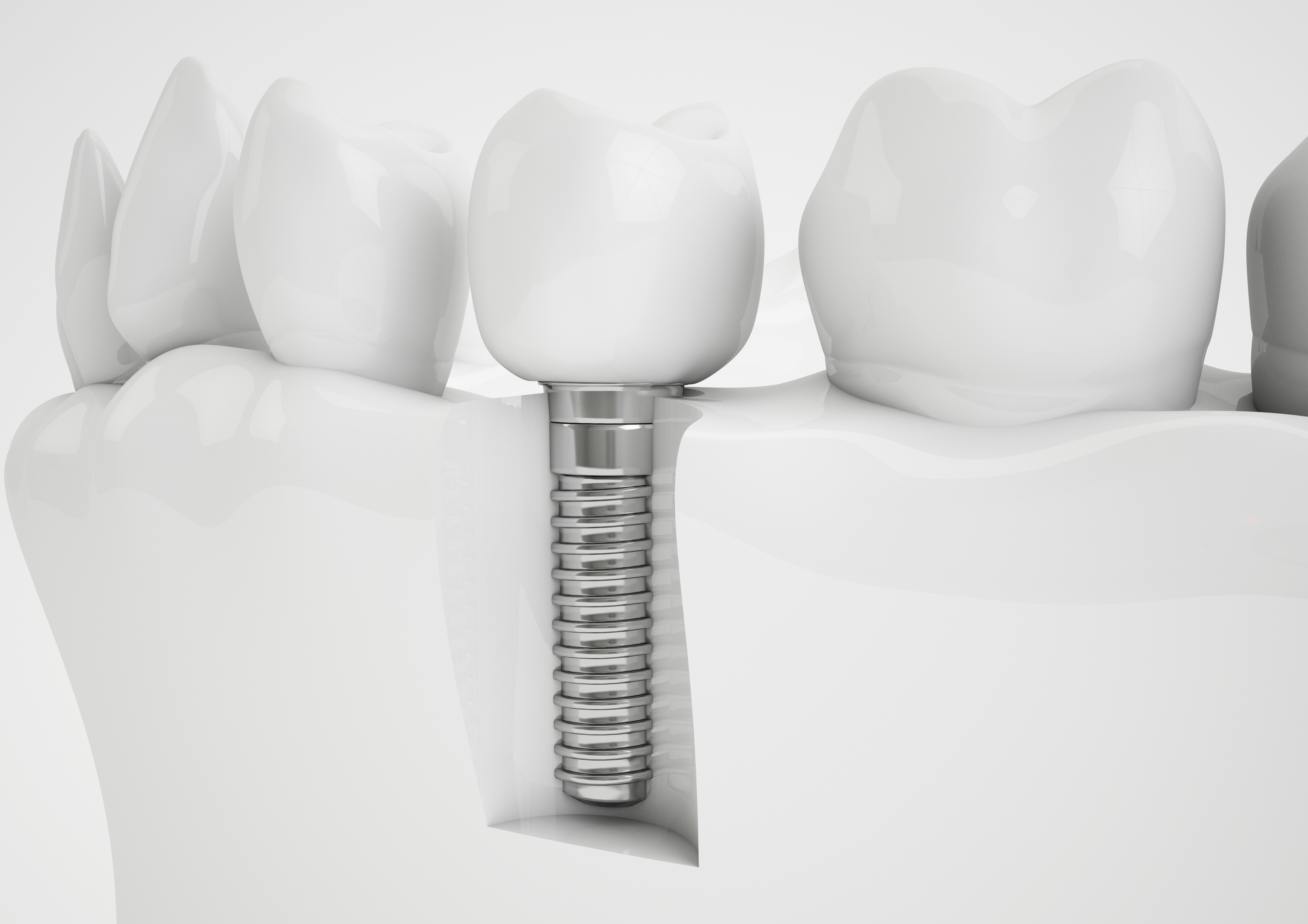 cuidar los implantes dentales