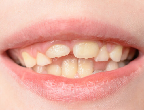 ¿Cómo actuar frente a una fractura en un diente de leche?