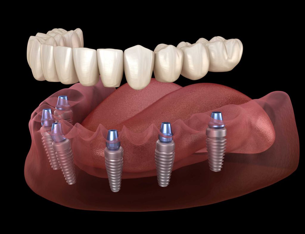 implantes dentales en Majadahonda, implantes dentales en Villanueva de la Cañada, implantología oral.
