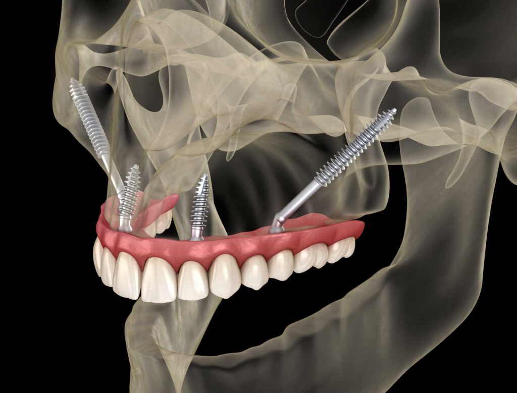 implantes dentales en Majadahonda, implantes dentales en Villanueva de la Cañada, implantología oral.